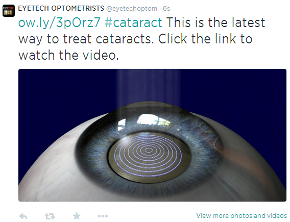 laser cataract